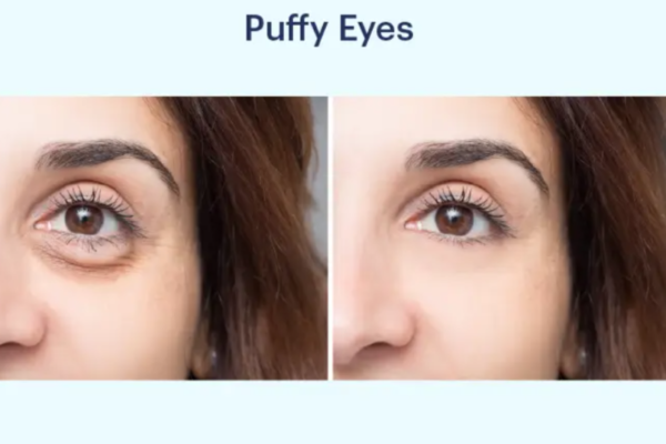 vitamin is good for puffy eyes
