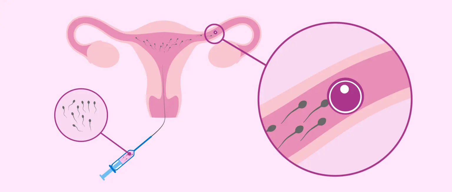 IUI Treatment Helps To Treat Hostile Uterus